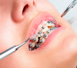Braces Cost in Hyderabad – Complete Guide