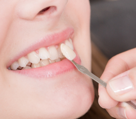 Dental Veneers Cost in Hyderabad