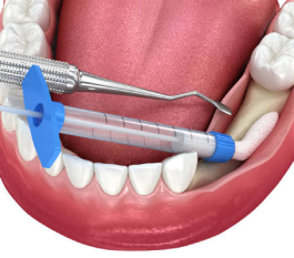 Flap Surgery in Hyderabad – Cost, Procedure & Expert Care By Toothy’s Dental Clinic