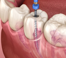 Root Canal Treatment Cost in Hyderabad