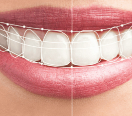 Smile Designing Cost in Hyderabad-Complete Guide