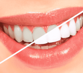 Teeth Whitening Cost in Hyderabad – A Complete Guide by Toothy’s Dental Clinic
