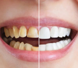Teeth Whitening Cost in Hyderabad